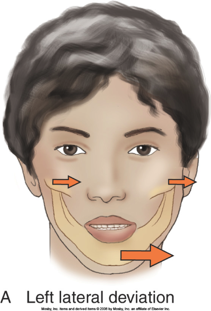 stop-jaw-clicking-popping-tmj-with-this-exercise-fix-with-jaw