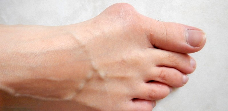 Photo of bunion for article "Physical Therapy for Bunion Pain, Discomfort and Embarrassment!"