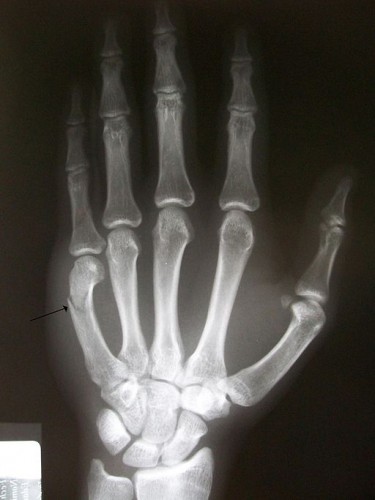 Physical Therapy for Boxer's Fracture | Capital Area PT
