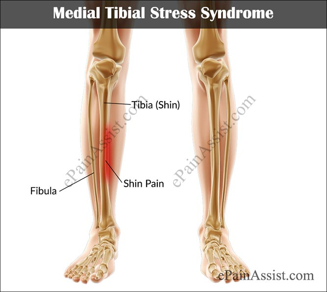 Medial Tibial Stress Syndrome Mtss Shin Splints Capital
